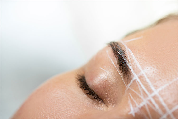Thread Lift