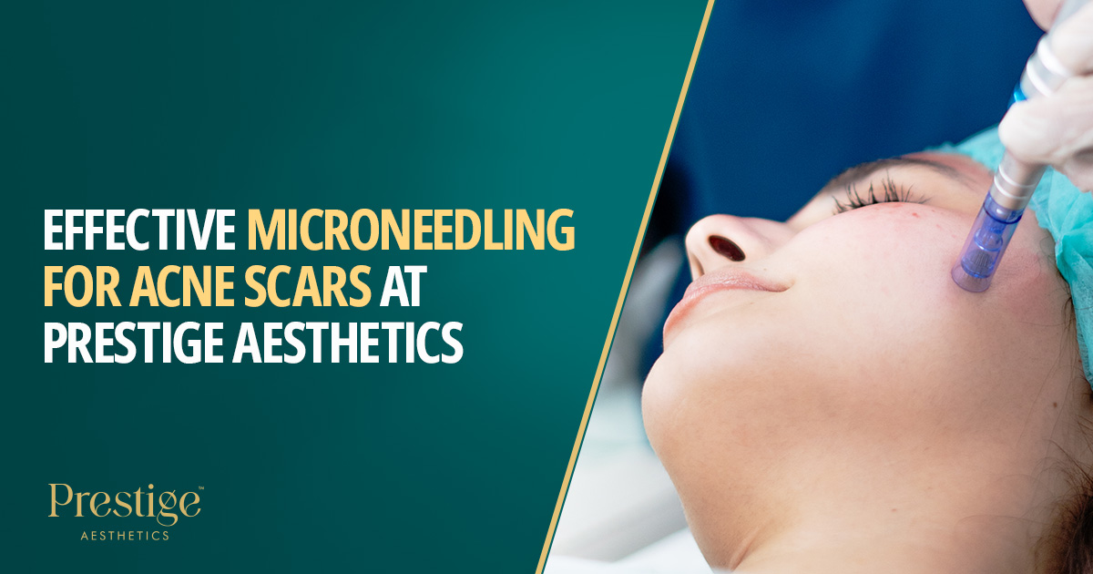 Effective Microneedling for Acne scars at prestige aesthetics